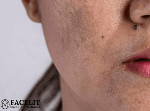 How to Reduce Pigmentation on the Face - Beauty/Fashion