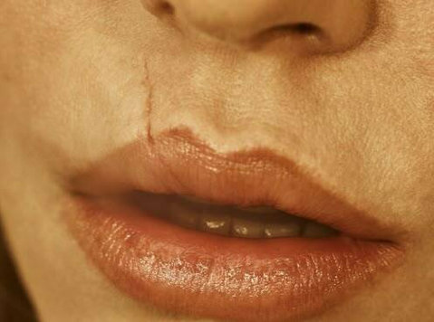 How to remove scars from face permanently - אופנה