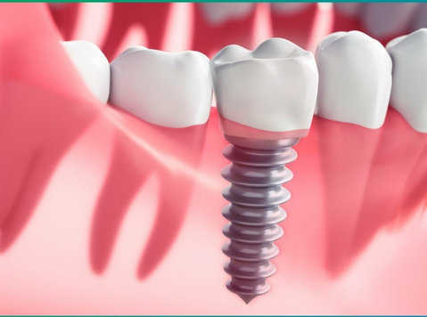 Regain Your Perfect Smile with Dental Implant Treatment! - Services: Other