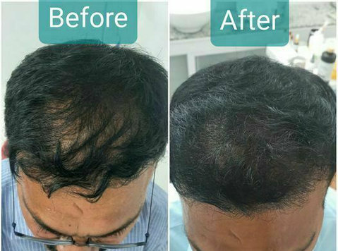 Best Hair Transplant Clinic in Jaipur - Ilu/Mood