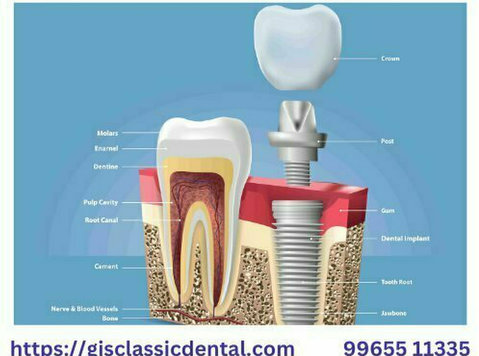 Dental Implants in Coimbatore | Implant Dentistry Coimbatore - Moda/Beleza