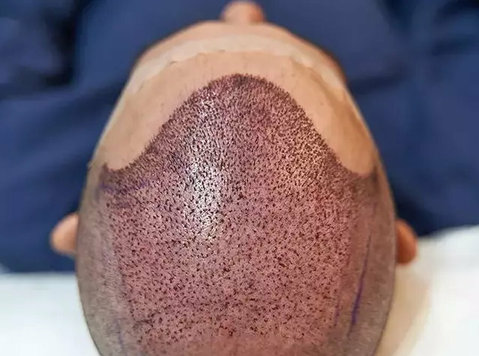 Hair Transplant in India - غيرها