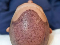 Hair Transplant in India - Inne