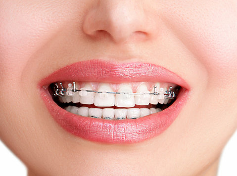 Damon Braces in Dubai - Muu