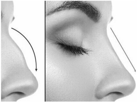 Rhinoplasty In Dubai - Dr Adnan Tahir - Khác