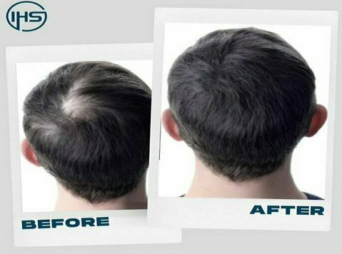 Non - Surgical Hair Replacement System in London, Uk - Ομορφιά/Μόδα