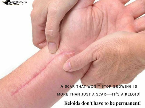 How do you know if you have a Keloid? Signs, Causes & Treatm - Schoonheid/Mode