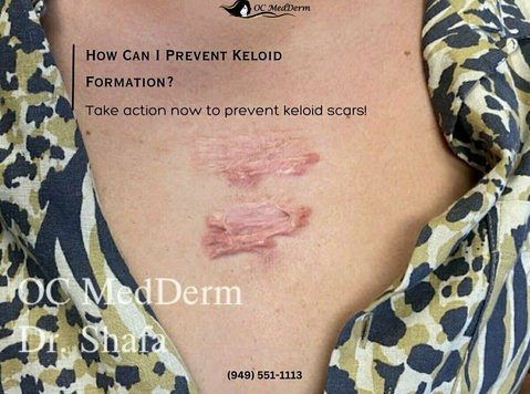 How Can I Prevent Keloid Formation? - Schoonheid/Mode