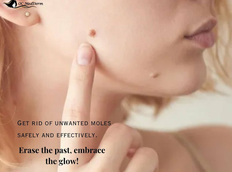 Mole Removal Treatment | Amazing Result in Irvine - Oc Medde - Schoonheid/Mode