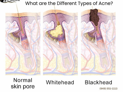 What are the Different Types of Acne? - Schoonheid/Mode
