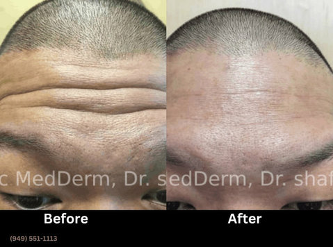 What are the side effects of Botox or Dysport? - Schoonheid/Mode