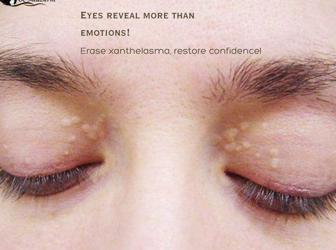 Xanthelasma, a red flag for risk of heart attack! - Schoonheid/Mode