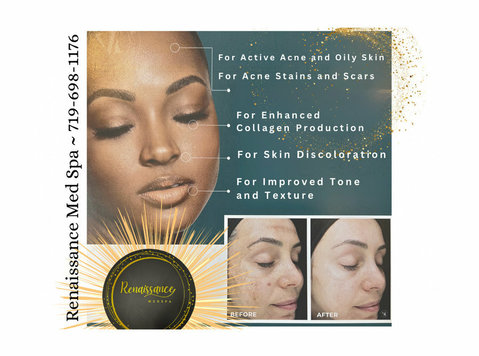 Revitalize Your Skin with Vi Peel Treatment in Colorado Spri - Beauty/Fashion