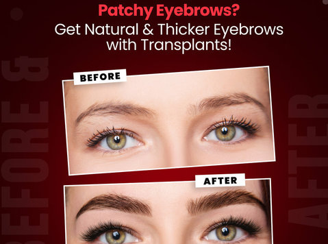 Transform Your Look with Expert Eyebrow Transplant in Boca R - Beauty/Fashion