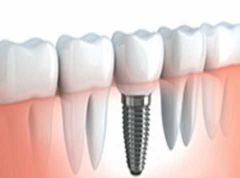 Winn Family Dentistry - Expert Dental Implants in Chippewa - Services: Other