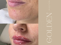 Golden Injectables (5) - Козметичната хирургия