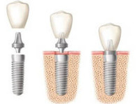 Tooth Implant Sydney (2) - Dentists