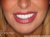 Sydney Dental Veneers (1) - Dentists