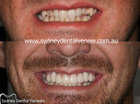 Sydney Dental Veneers (2) - Dentists