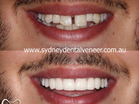 Sydney Dental Veneers (3) - Dentists