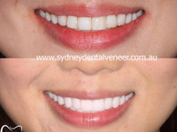 Sydney Dental Veneers (4) - Dentists