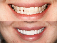 Sydney Dental Crowns (2) - Dentists