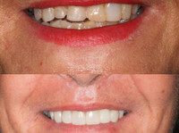 Sydney Dental Crowns (3) - Dentists