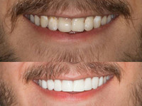 Sydney Dental Crowns (4) - Dentists