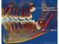 Wisdom Teeth Dentist (1) - ڈینٹسٹ/دندان ساز