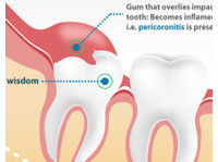 Wisdom Teeth Dentist (2) - Dentistas