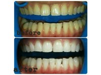 H-Smile Teeth Whitening and Dental Hygiene (1) - Dentistes