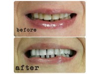 H-Smile Teeth Whitening and Dental Hygiene (3) - Zubní lékař