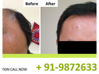 Natural Hair Transplant Hyderabad (1) - Alternativní léčba