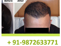 Natural Hair Transplant Hyderabad (2) - Medicina alternativa