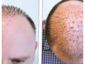 Hair Transplant Clinic In Delhi - Cosmetic surgery