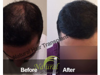 Natural Hair Transplant India (1) - Hospitais e Clínicas