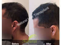 Natural Hair Transplant India (2) - Hospitais e Clínicas