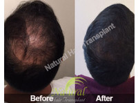 Natural Hair Transplant India (3) - Болници и клиники