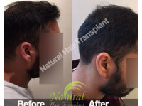Natural Hair Transplant India (4) - Spitale şi Clinici