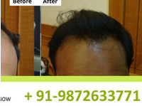 Nht Hair Transplant center Bangalore (1) - Alternative Healthcare