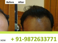 Nht Hair Transplant Center Mumbai (1) - Фризери