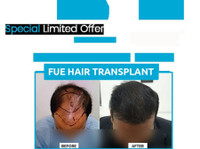 Nht Hair Transplant Center Mumbai (3) - Фризери