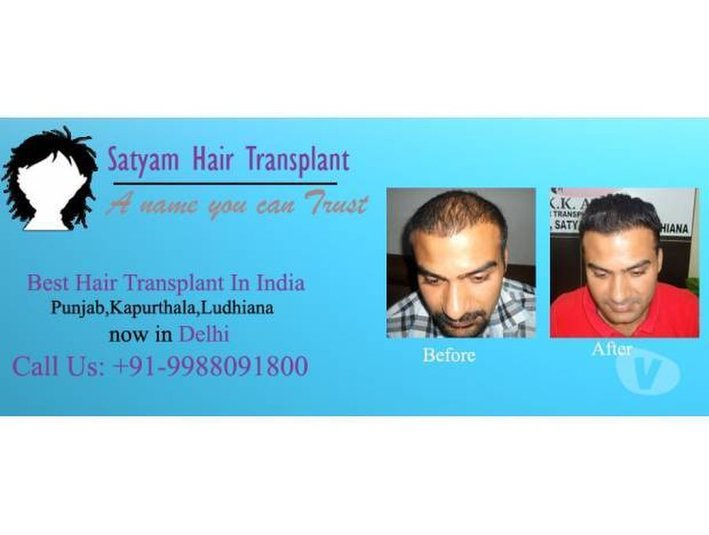 Hair Transplant Treatment by Satyam - Cosmetic surgery