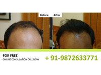 Natural Hair Transplant Ludhiana (1) - Hairdressers