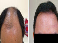 Natural Hair Transplant Chennai (3) - Alternative Healthcare