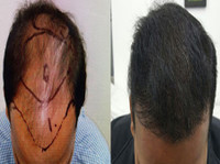 Natural Hair Transplant Chennai (4) - Alternative Healthcare