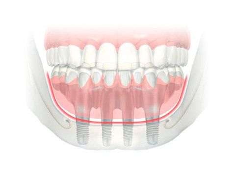 winston omp advanced dental implantology - Stomatologi