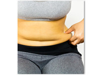 Liposuction makes you look fit and healthy - Cirurgia plástica