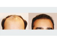 Hair Transplant Clinic Dubai (3) - ہاسپٹل اور کلینک