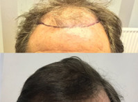 Harris Hair Transplant UK (2) - Chirurgie Cosmetică